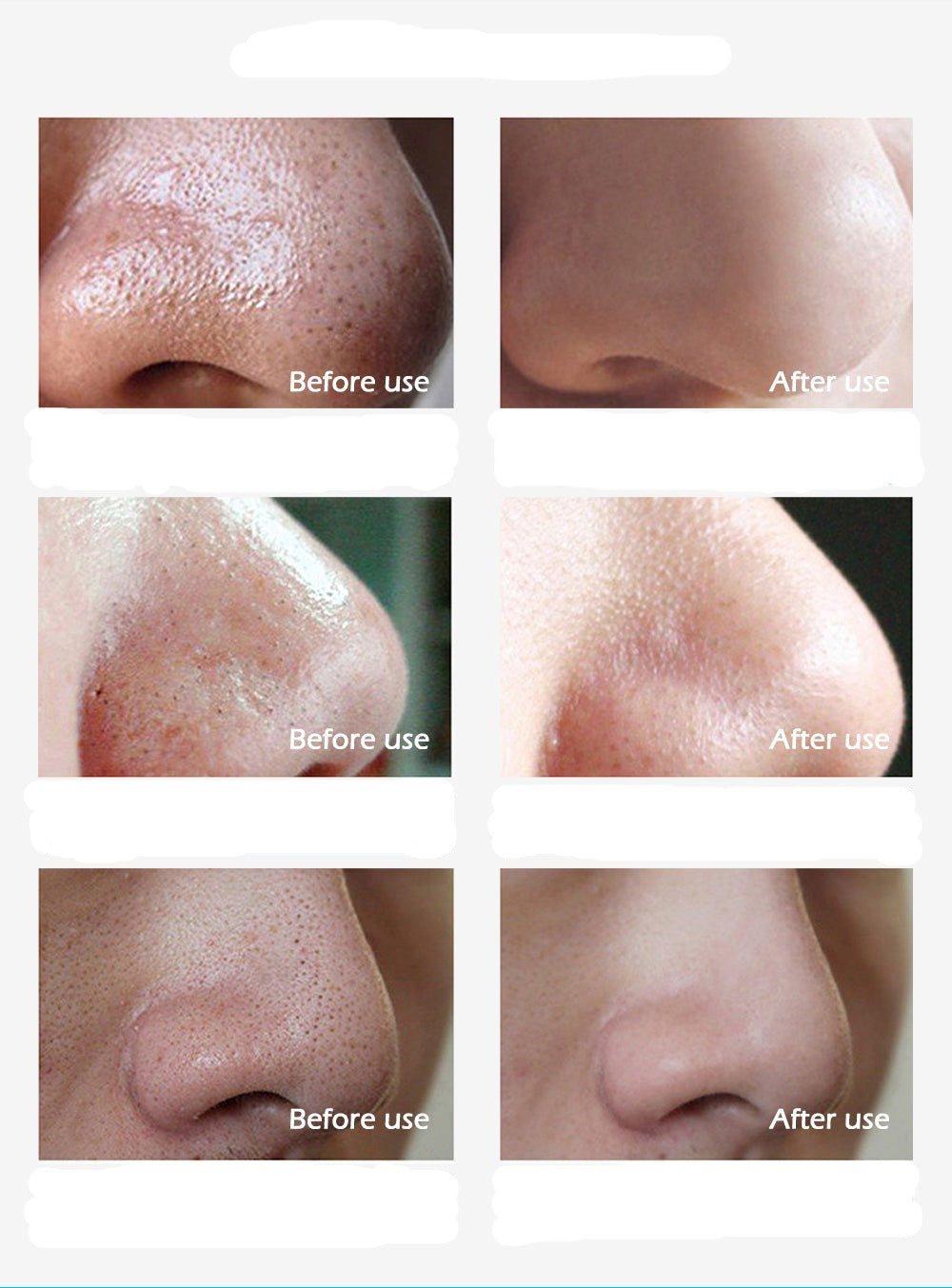 Blackhead Remover Strips