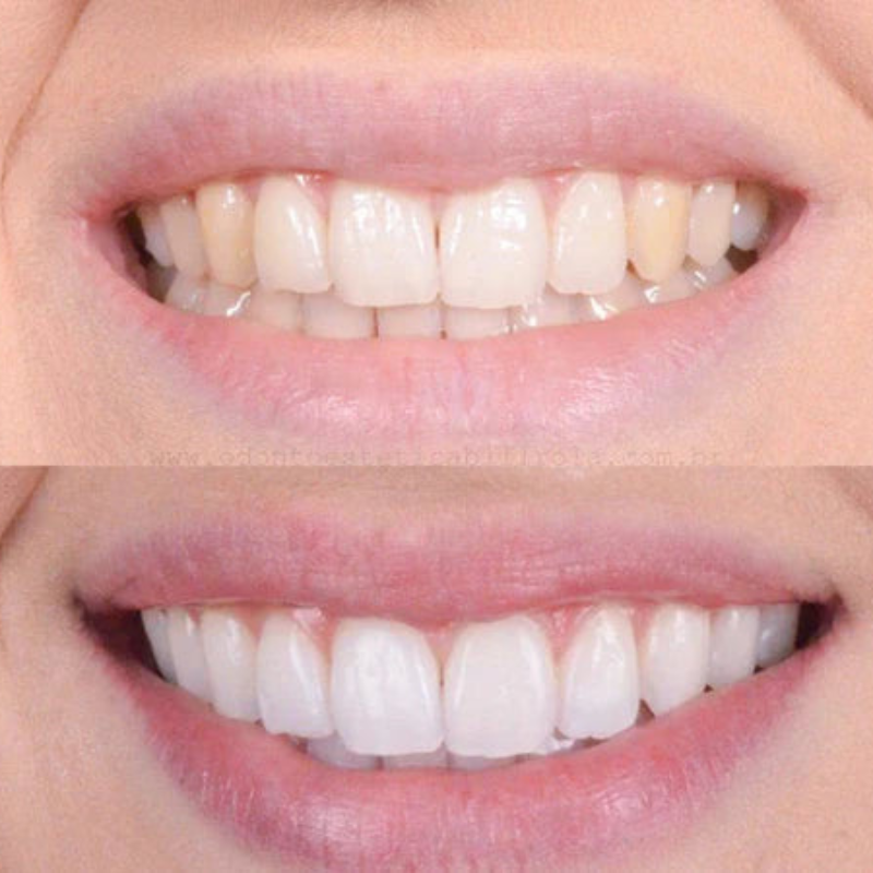 Quick Teeth Whitening Pen