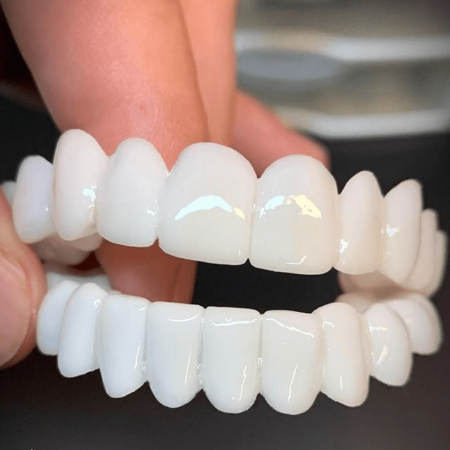 Dental Prosthesis with White Dental Veneers