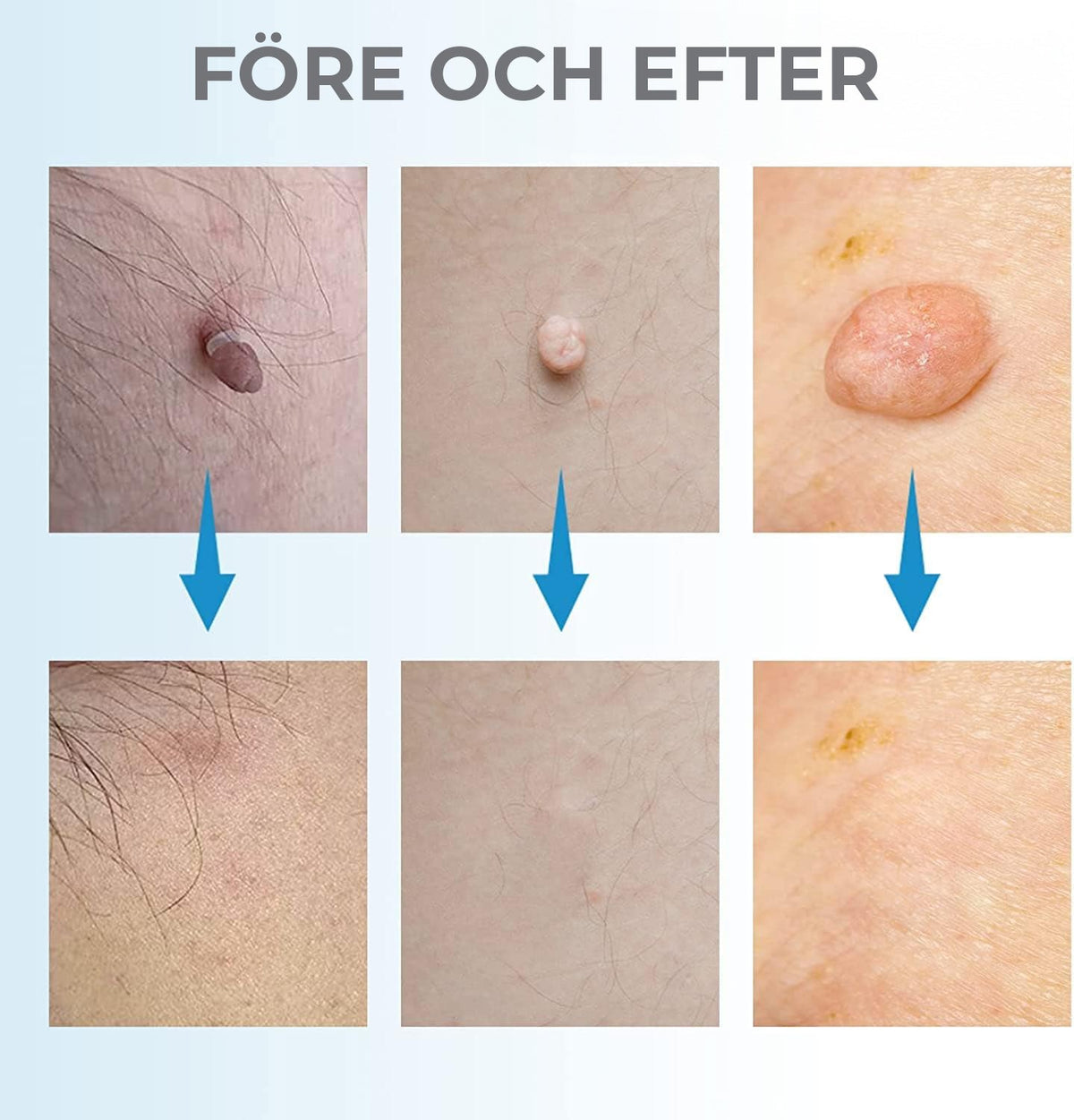 Liver Spot and Birthmark Remover