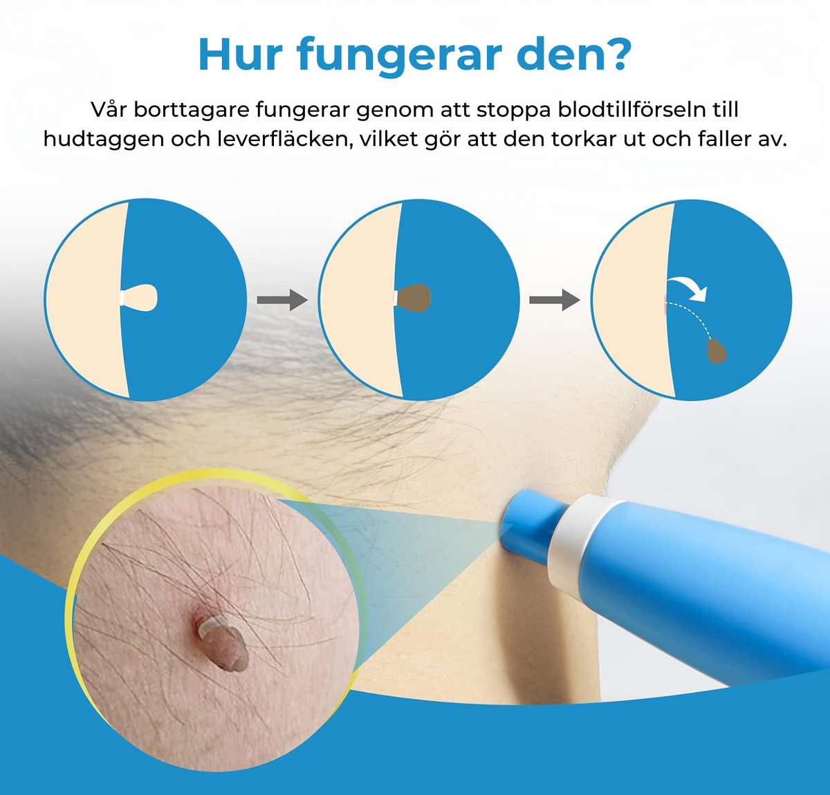 Liver Spot and Birthmark Remover