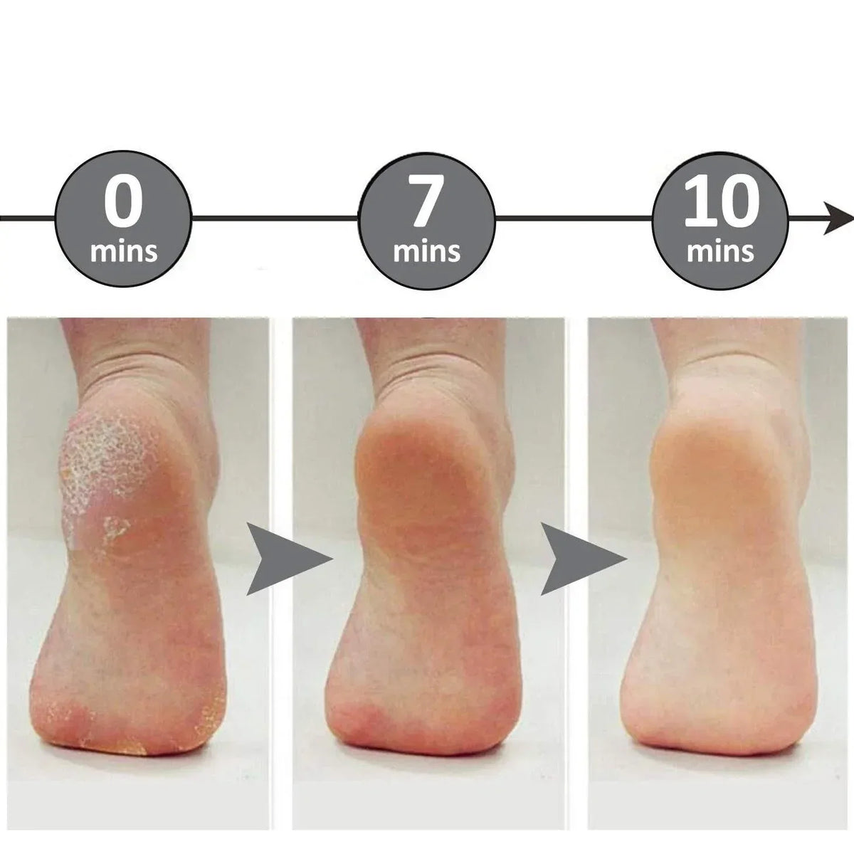 Professional Foot File Callus Remover