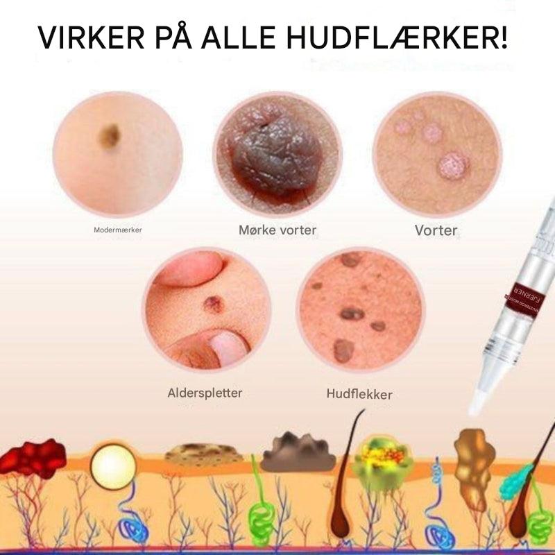 Skin Tag and Mole Remover