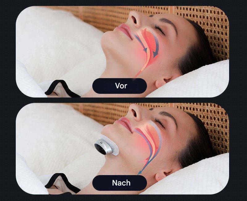 Sleep Apnea Device