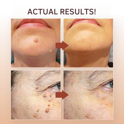 Wart Removal | Precision Applicator for Targeted Treatment | Plant-Based Care Formula