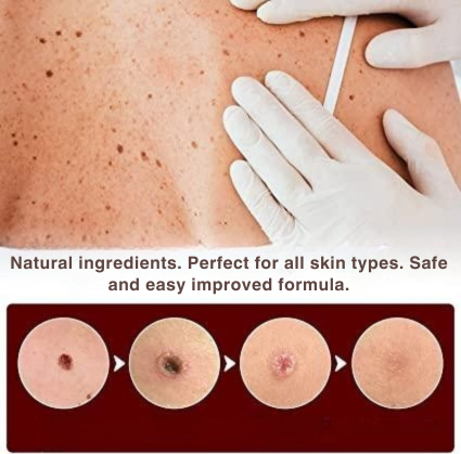 Wart Removal | Precision Applicator for Targeted Treatment | Plant-Based Care Formula