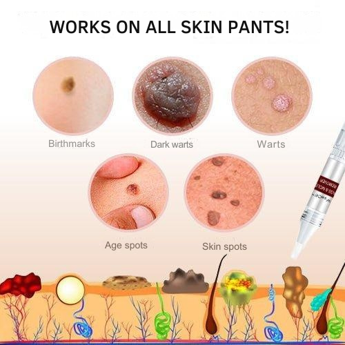 Wart Removal | Precision Applicator for Targeted Treatment | Plant-Based Care Formula