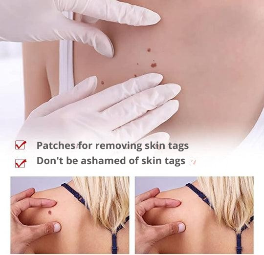 Wart Removal | Precision Applicator for Targeted Treatment | Plant-Based Care Formula